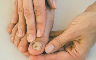 How to avoid Fungal Nails