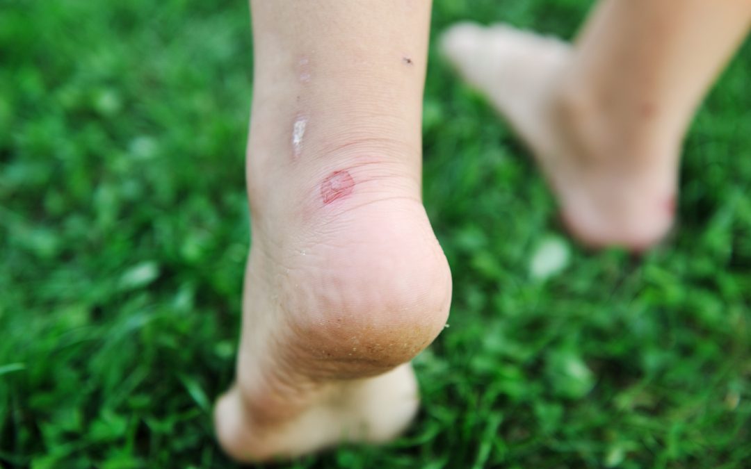 Blisters: How to prevent and treat them