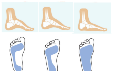 What is your foot type?