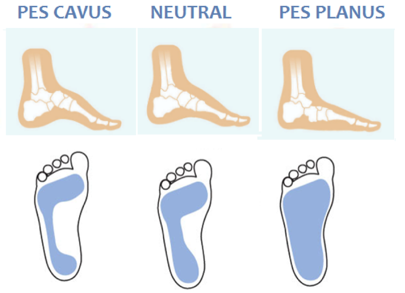 What is your foot type?