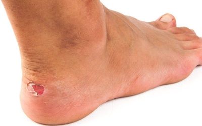 Top Tips to Prevent & Treat Blisters