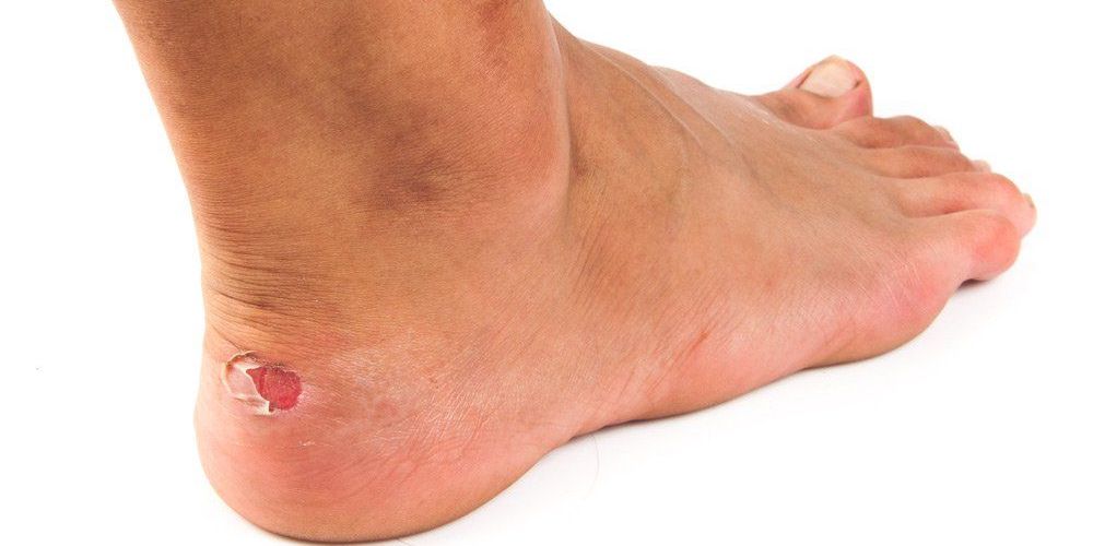 Top Tips to Prevent & Treat Blisters
