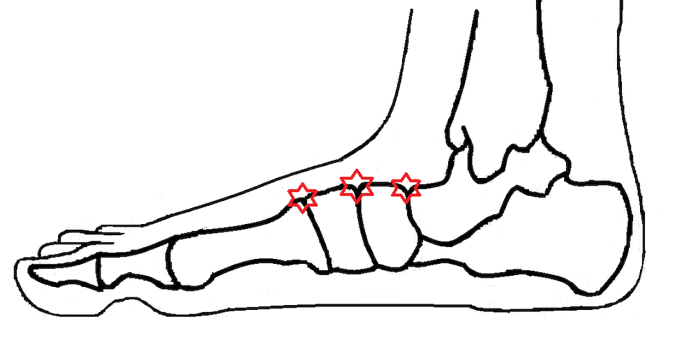 Dorsal Compression Syndrome, foot bones